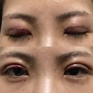 1日目の経過画像（1枚目）