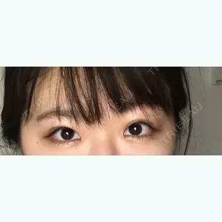 14日目の経過画像（1枚目）