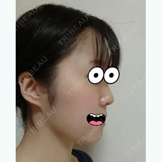 8日目の経過画像（1枚目）