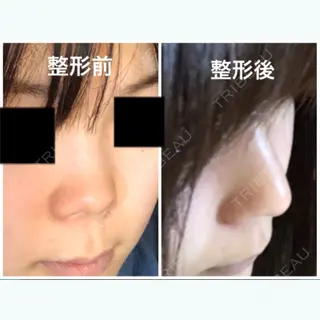 44日目の経過画像（2枚目）