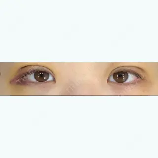 4日目の経過画像（1枚目）