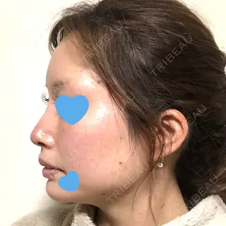 7日目の経過画像（3枚目）