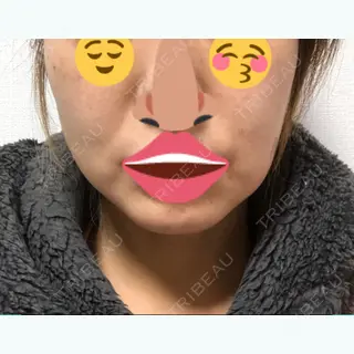 6日目の経過画像（1枚目）
