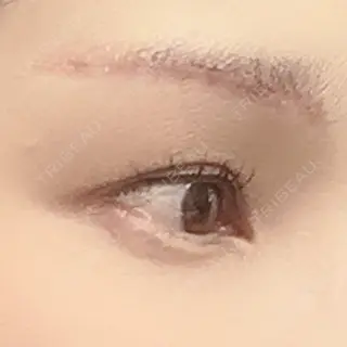 8日目の経過画像（3枚目）