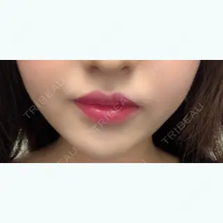 2日目の経過画像（1枚目）