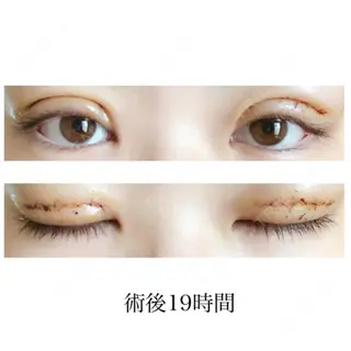 1日目の経過画像（1枚目）