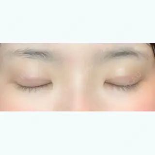 4日目の経過画像（2枚目）