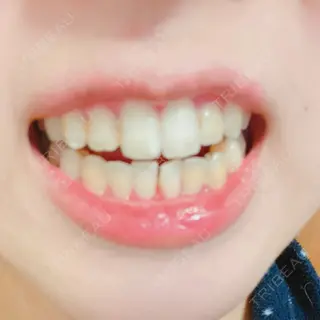 60日目の経過画像（2枚目）