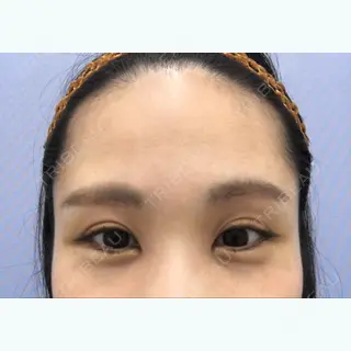 31日目の経過画像（1枚目）