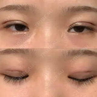 0日目の経過画像（1枚目）
