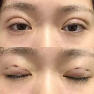 0日目の経過画像（1枚目）