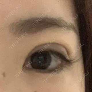 6日目の経過画像（1枚目）