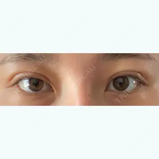 2日目の経過画像（1枚目）
