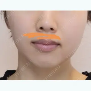 18日目の経過画像（1枚目）