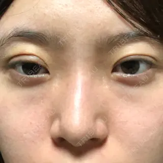 4日目の経過画像（1枚目）