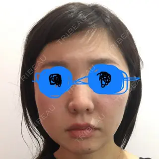 99日目の経過画像（1枚目）