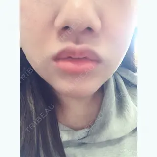 1日目の経過画像（1枚目）
