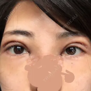 2日目の経過画像（2枚目）