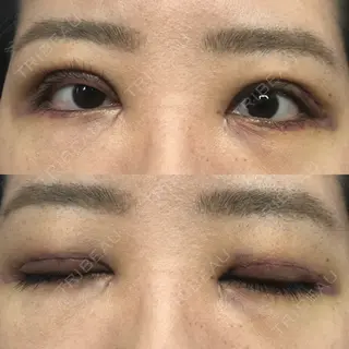 4日目の経過画像（1枚目）