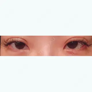 1日目の経過画像（2枚目）