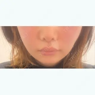 2日目の経過画像（1枚目）