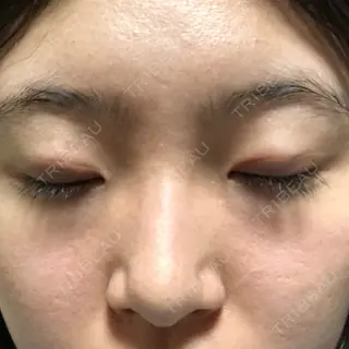 6日目の経過画像（2枚目）