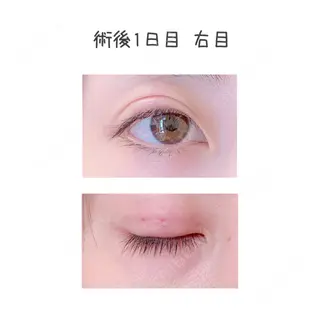 1日目の経過画像（1枚目）