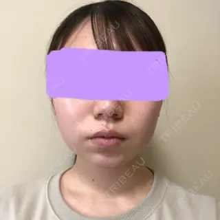 16日目の経過画像（1枚目）