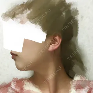 24日目の経過画像（2枚目）