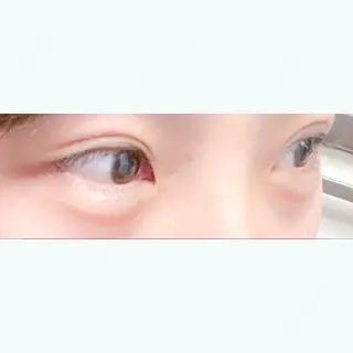 15日目の経過画像（3枚目）