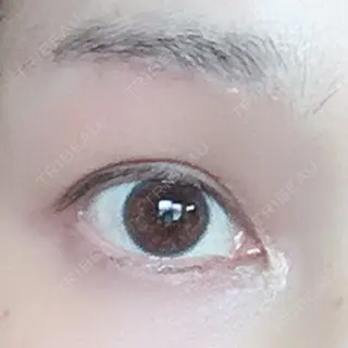 17日目の経過画像（1枚目）