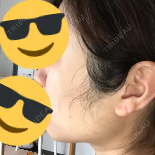 8日目の経過画像（3枚目）