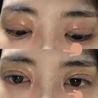 3日目の経過画像（2枚目）