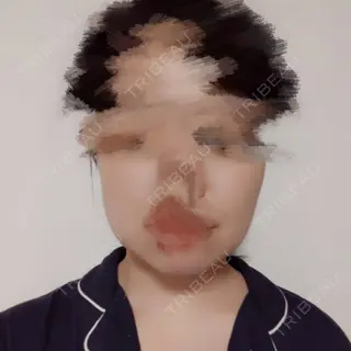 4日目の経過画像（1枚目）