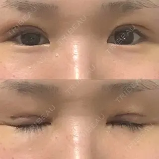 6日目の経過画像（1枚目）