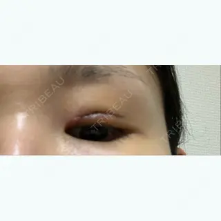 6日目の経過画像（2枚目）