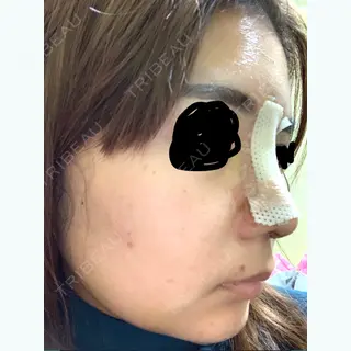 6日目の経過画像（2枚目）
