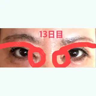 13日目の経過画像（1枚目）