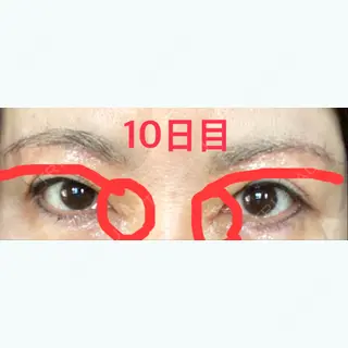 10日目の経過画像（1枚目）