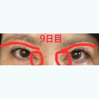 9日目の経過画像（1枚目）