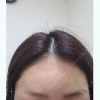 1日目の経過画像（3枚目）