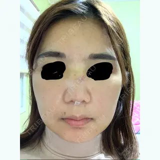 7日目の経過画像（1枚目）