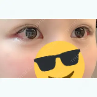 4日目の経過画像（1枚目）