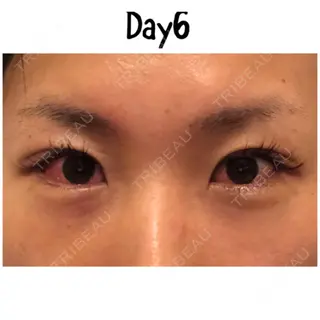 6日目の経過画像（2枚目）
