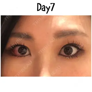 7日目の経過画像（2枚目）