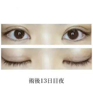 13日目の経過画像（1枚目）
