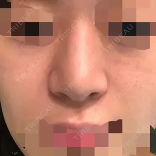 60日目の経過画像（1枚目）