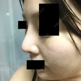 18日目の経過画像（2枚目）