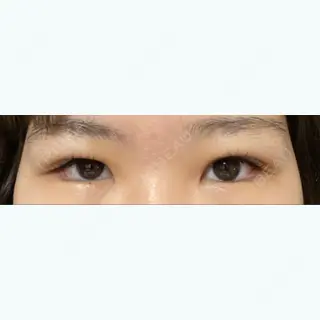 29日目の経過画像（1枚目）