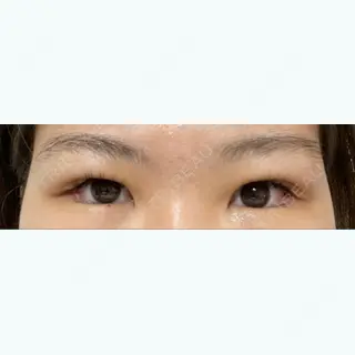 34日目の経過画像（1枚目）